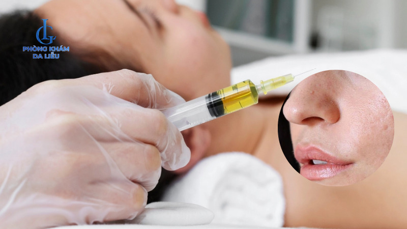 điều trị sẹo rỗ do mụn