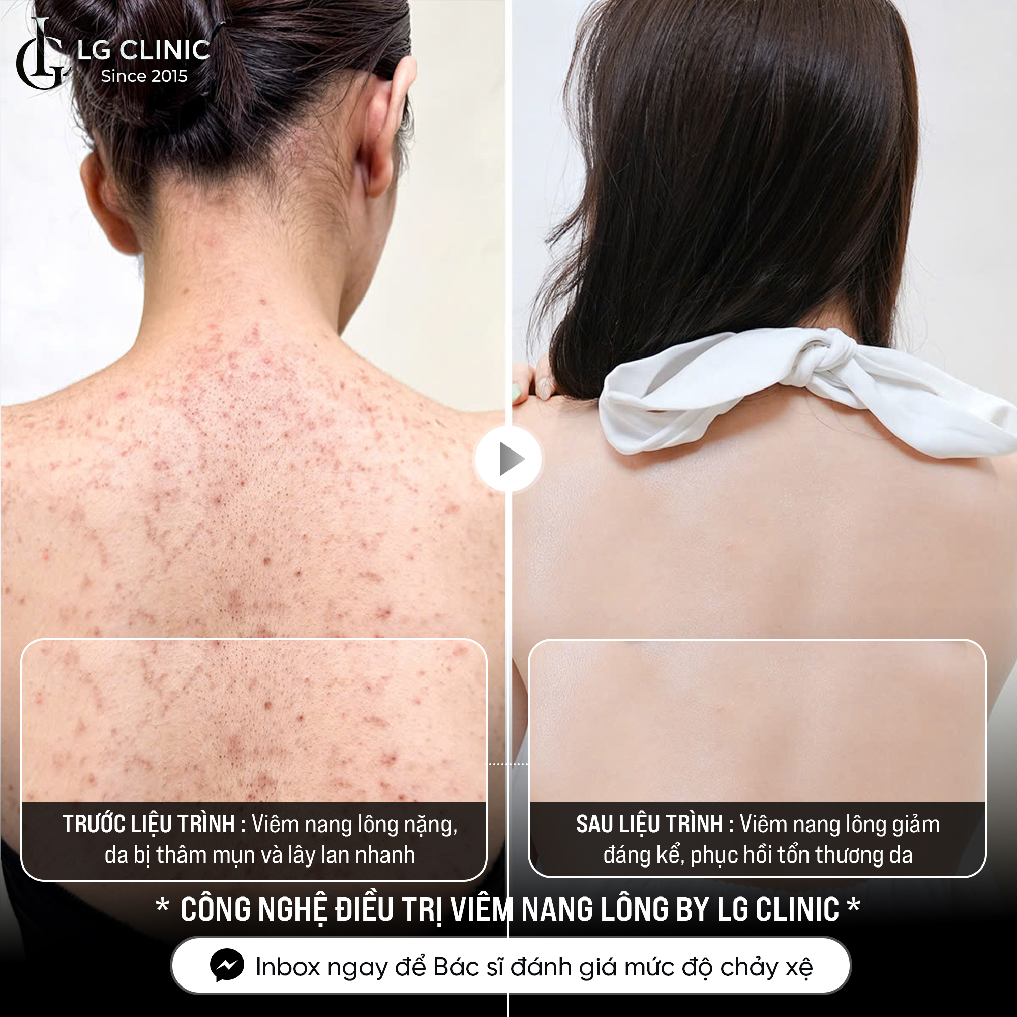 B-A điều trị viêm nang lông