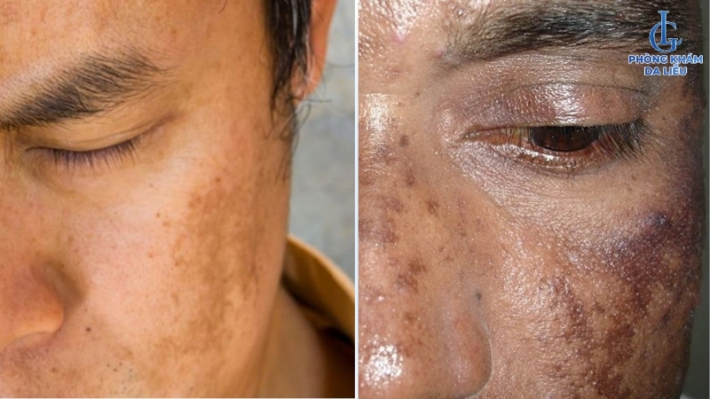 hình ảnh bị nám ở nam giới