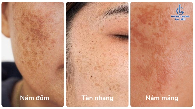 hình ảnh nám đốm