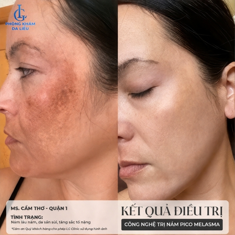 kết quả sau khi điều trị nám bằng laser