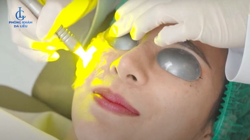 điều trị sẹo rỗ bằng laser