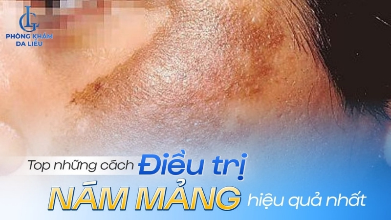 nám mảng là gì