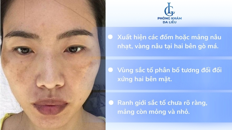 nám nhẹ 2 bên gò má