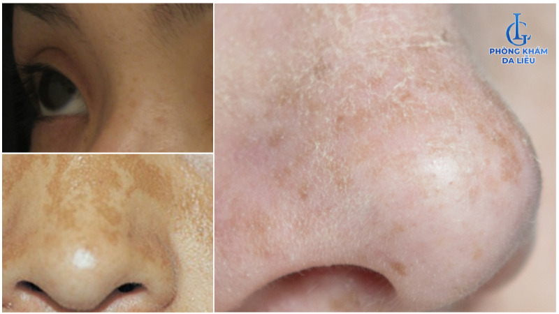 nám ở sống mũi