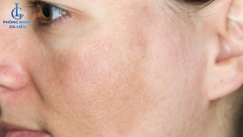 người bị nám nông có thể peel da trị nám