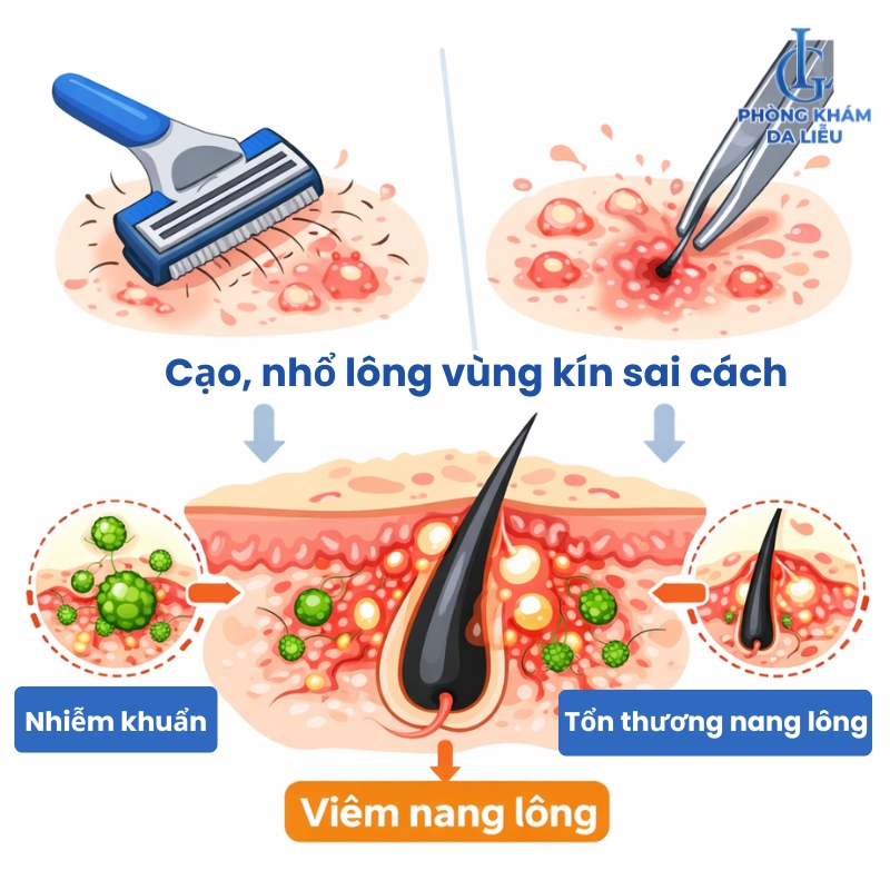nguyên nhân gây viêm nang lông vùng kín nam giới