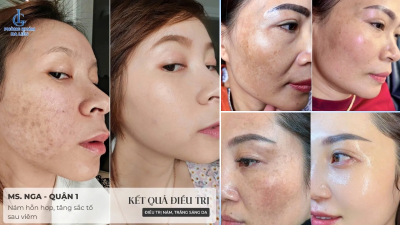 peel da trị nám ở đâu uy tín