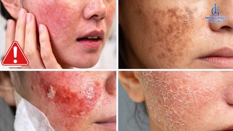 Rủi ro khi peel da trị nám sai cách