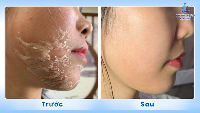 peel da trị nám có hiệu quả không