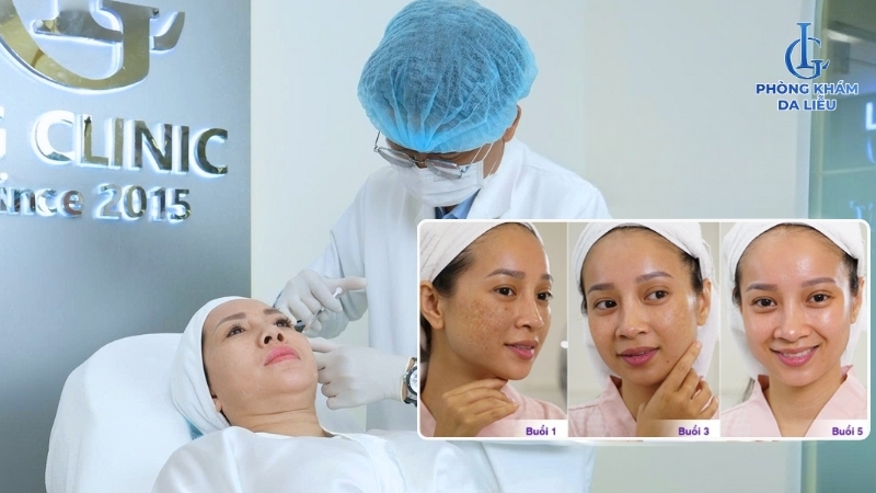 tiêm meso trị nám có hiệu quả không