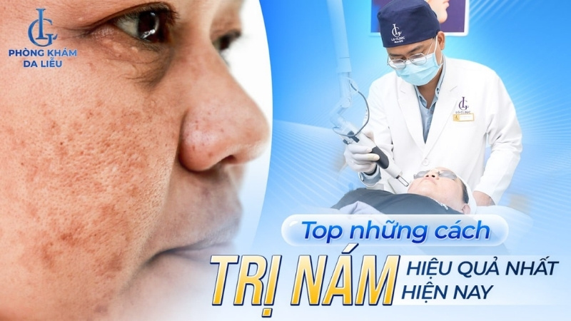 top những cách trị nám hiệu quả nhất hiện nay