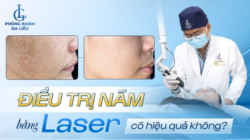 trị nám bằng laser có hiệu quả hay không