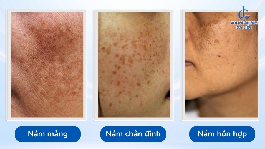 Các loại nám da mặt