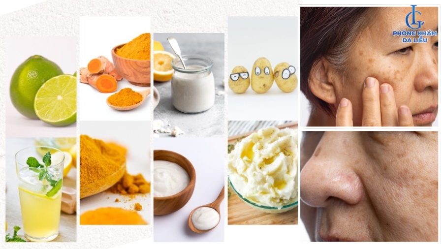 Trị nám da mặt bằng nguyên liệu thiên nhiên