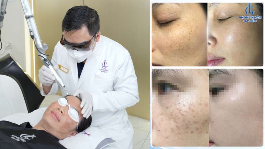 Điều trị nám da mặt