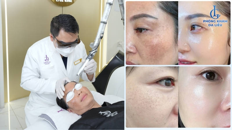 trị nám nhẹ 2 bên gò má