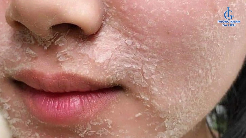 trị nám ở sống mũi