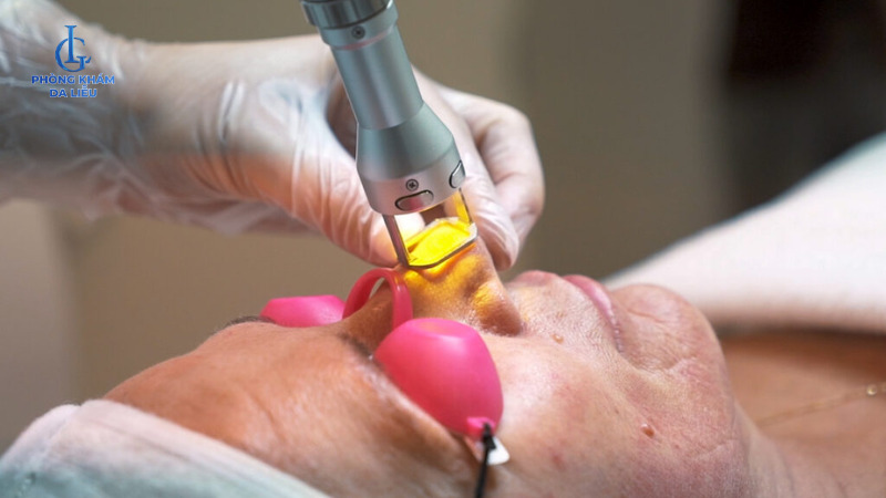 trị sẹo rỗ bằng laser