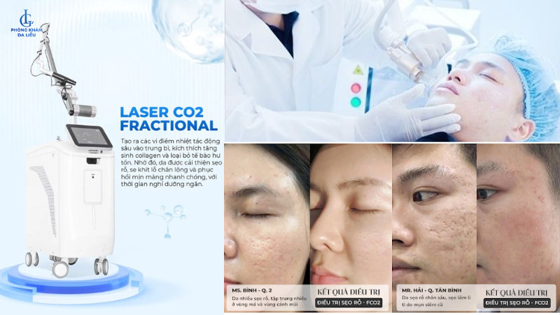trị sẹo rỗ bằng laser