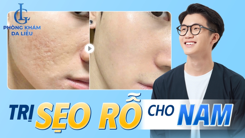 trị sẹo rỗ cho nam