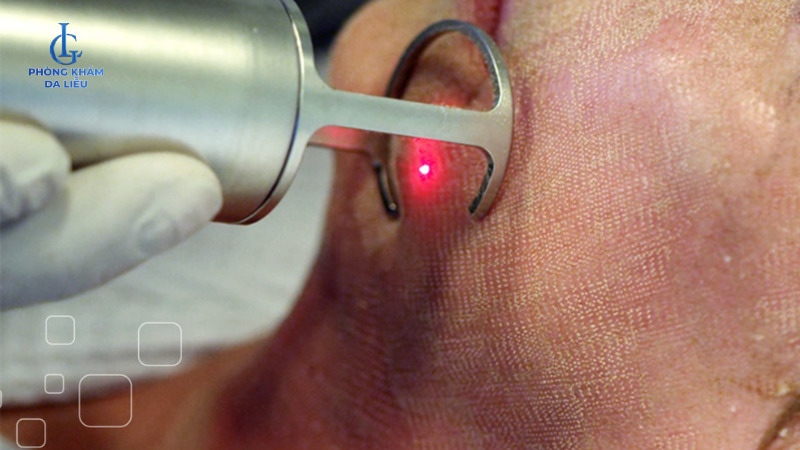 trị sẹo rỗ cho nam bằng laser co2