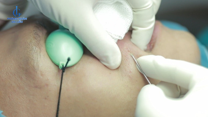 trị sẹo rỗ cho nam bóc tách đáy sẹo