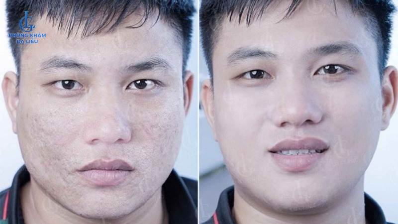 trị sẹo rỗ cho nam hiệu quả