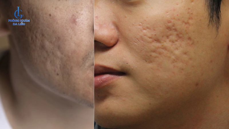 trị sẹo rỗ cho nam