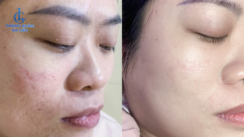 trị sẹo rỗ do mụn hiệu quả