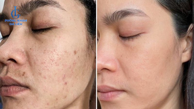 trị sẹo rỗ do mụn ở phòng khám