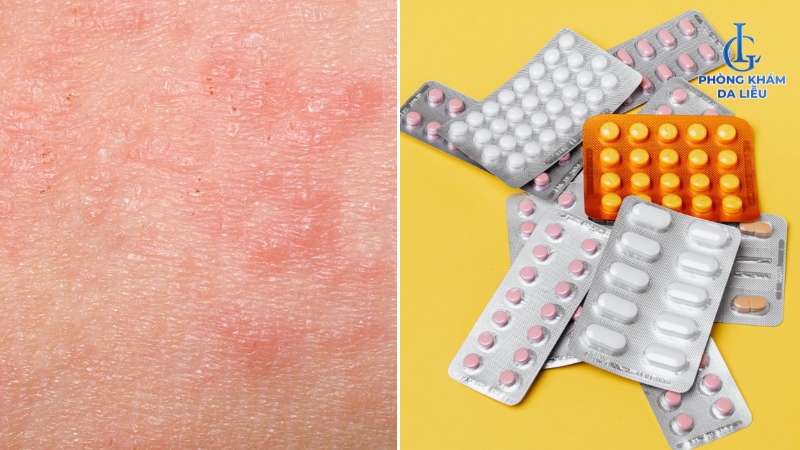 trị viêm lỗ chân lông ở bụng