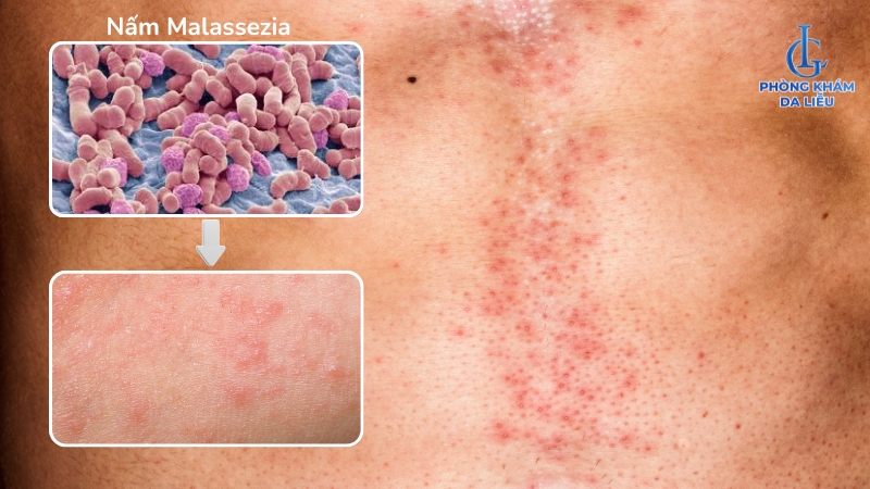 viêm lỗ chân lông ở bụng do vi khuẩn