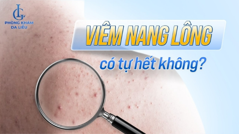 viêm nang lông có tự hết không