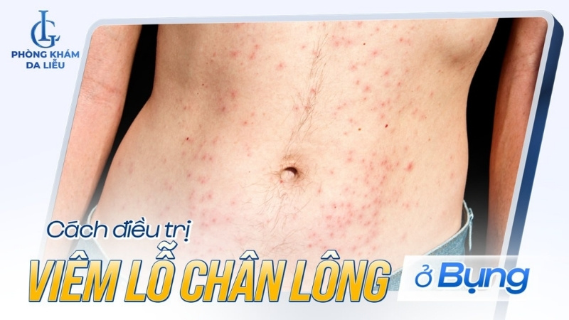 viêm nang lông ở bụng