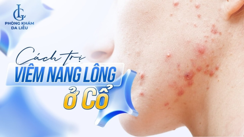 viêm nang lông ở cổ