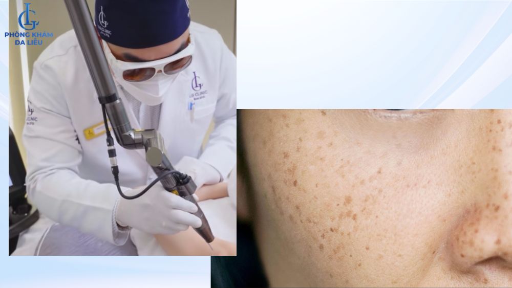 xóa tàn nhang bằng laser