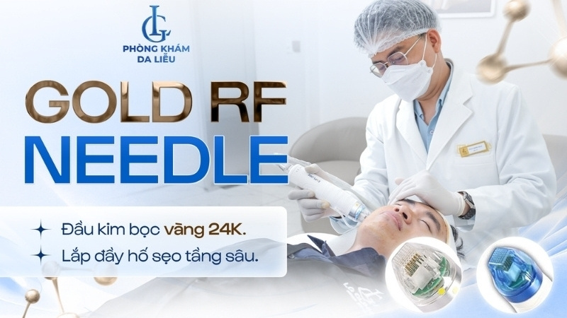 RF needle điều trị sẹo đáy tròn