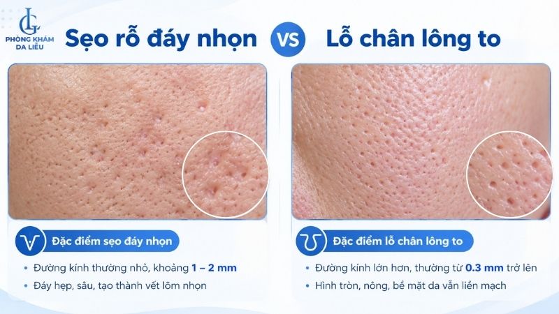 Phân biệt sẹo đáy nhọn và lỗ chân lông to