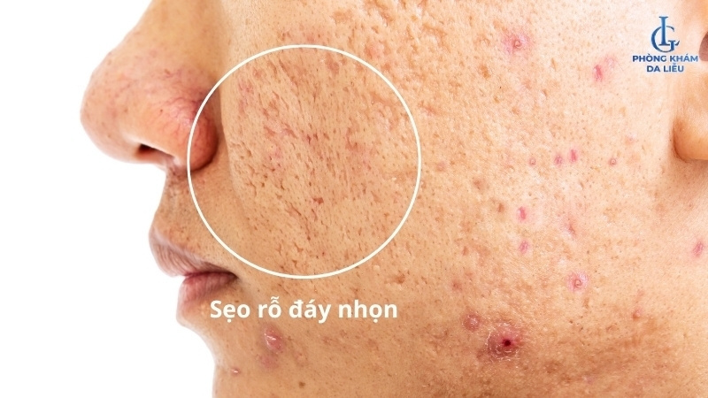 Sẹo rỗ đáy nhọn