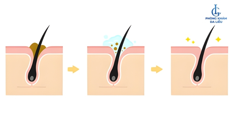 aspirin điều trị viêm nang lông