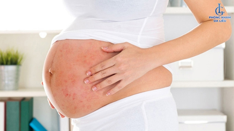 bà bầu bị viêm lỗ chân lông