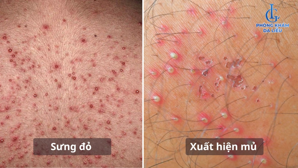 bệnh viêm nang lông có lây hay không