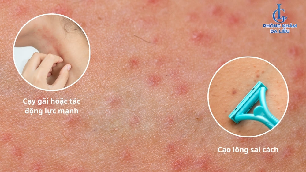 bệnh viêm nang lông có lây không