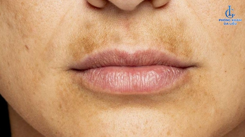 bị nám da quanh miệng do thiếu vitamin