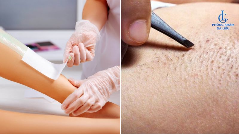 bị viêm lỗ chân lông có nên triệt lông không