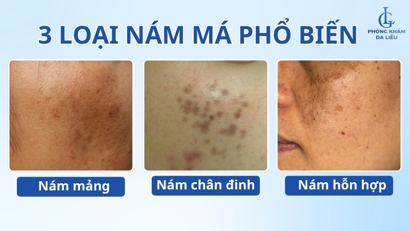 các loại nám da mặt vùng má