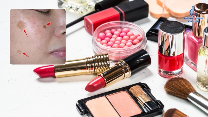 các nguyên nhân gây nám da