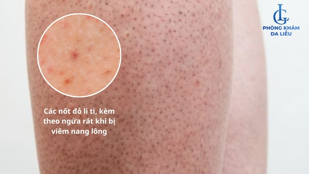 cách chữa lỗ chân lông to ở chân