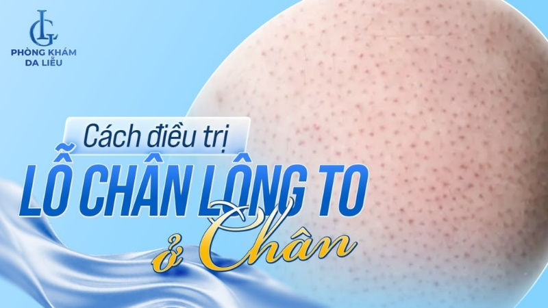 cách điều trị lỗ chân lông to ở chân